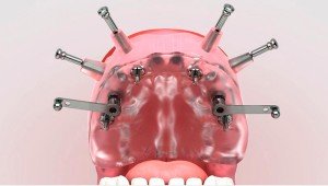 Modalidades de implantes dentales