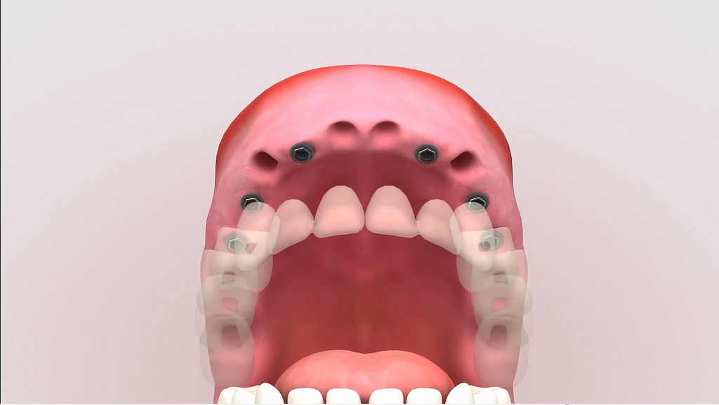 tipologia implantes dentales