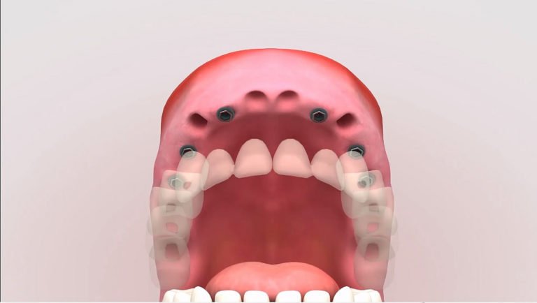 tipologia implantes dentales